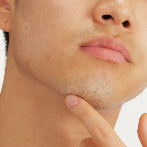 Rutina de skincare para pieles grasas con tendencia acneica